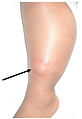 Tuberculosis leg swelling.jpg