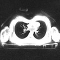 File:Time-Efficient-3D-Radial-UTE-Sampling-with-Fully-Automatic-Delay-Compensation-on-a-Clinical-3T-MR-pone.0150371.s003.ogv